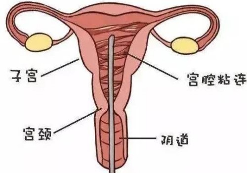 杭州助孕公司：囊胚移植第9天姨妈感强，看下出血量情况